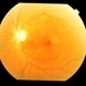 Dengue Retinitis