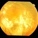 exudative AMD