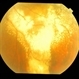 exudative AMD