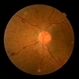 Florid Type PDR and Venous Loop