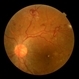 Florid Type PDR and Venous Loop