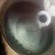 Persistent Fetal Vasculature