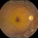 Macroaneurysm