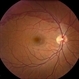 Subhyaloid Hemorrhage