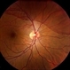 Subhyaloid Hemorrhage