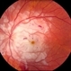 Purtscher's Retinopathy