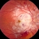 Purtscher's Retinopathy