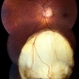 Retinal Coloboma