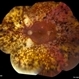 Laser Scars Due to Diabetic Retinopathy