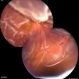 Retinal Detachment With Dislocated IOL Lens