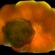 Choroidal Hemorrhage