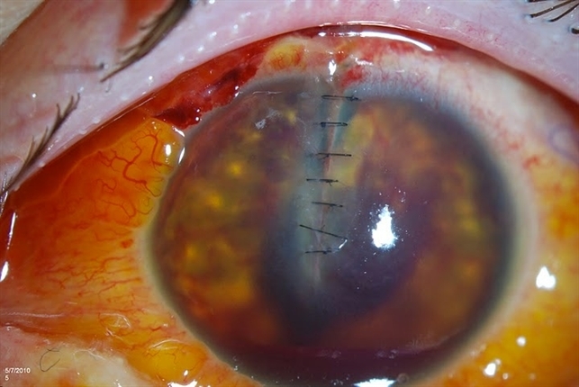 Ruptured Globe Trauma Retina Image Bank Ruptured Globe Trauma Retina Image Bank