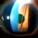 Bleb Needling, Blood Streaming in Anterior Chamber