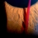 Bleb Needling, Blood Streaming in Anterior Chamber