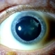 'Flower Cataract'