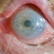 Corneal Abrasion