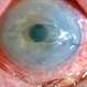 Corneal Abrasion