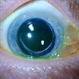 Conjunctival Cyst