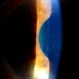 Pseudoexfoliation