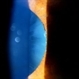Pseudoexfoliation