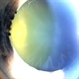 Pseudoexfoliation