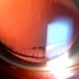 Pigmentary Glaucoma, Zonules Visible Inferiorly