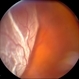 Retinal Detachment