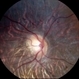 Myopic Shift With Tilted Optic Disc.