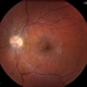 Leukemic Retinopathy