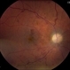 Leukemic Retinopathy