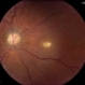 Leukemic Retinopathy