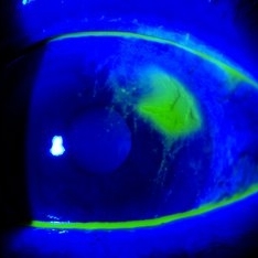 Corneal Abrasion with Foreign Body Present - Retina Image Bank