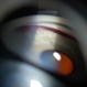 Gonioscopy, Blood in the Anterior Chamber from Hyphema