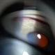 Gonioscopy, Blood in the Anterior Chamber from Hyphema