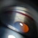 Gonioscopy, Blood in the Anterior Chamber from Hyphema