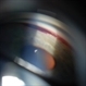 Gonioscopy, Blood in the Anterior Chamber from Hyphema