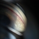 Gonioscopy, Blood in the Anterior Chamber from Hyphema
