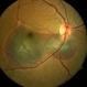 Subfoveal Subretinal Hemorrhage Subfoveal Subretinal Hemorrhage