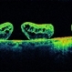 Full-thickness Macular Hole