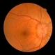 Papilledema