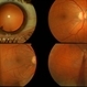 Metallic intraocular foreign body - colour composite image