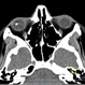 Metallic intraocular foreign body - CT scan Metallic intraocular foreign body - CT scan