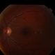Idiopathic Perifoveal Telangiectasia