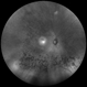 Sector Retinitis Pigmentosa Sector Retinitis Pigmentosa