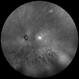 Sector Retinitis Pigmentosa Sector Retinitis Pigmentosa