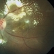 Idiopathic Retinal Vasculitis, Aneurysms, and Neuroretinitis (IRVAN)
