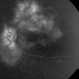 Idiopathic Retinal Vasculitis, Aneurysms, and Neuroretinitis (IRVAN) Idiopathic Retinal Vasculitis, Aneurysms, and Neuroretinitis (IRVAN)