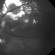 Idiopathic Retinal Vasculitis, Aneurysms, and Neuroretinitis (IRVAN) Idiopathic Retinal Vasculitis, Aneurysms, and Neuroretinitis (IRVAN)