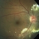Idiopathic Retinal Vasculitis, Aneurysms, and Neuroretinitis (IRVAN) Idiopathic Retinal Vasculitis, Aneurysms, and Neuroretinitis (IRVAN)