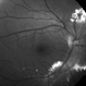 Idiopathic Retinal Vasculitis, Aneurysms, and Neuroretinitis (IRVAN) Idiopathic Retinal Vasculitis, Aneurysms, and Neuroretinitis (IRVAN)